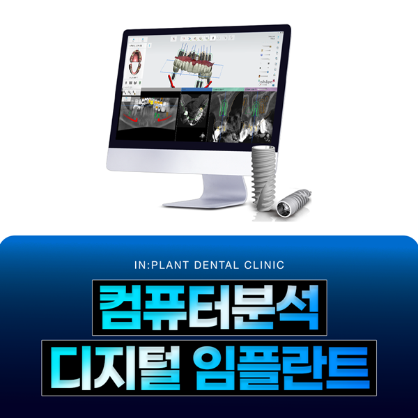 컴퓨터분석 디지털 임플란트